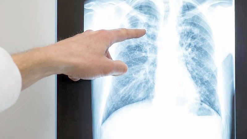 Röntgenbild einer Lunge im Vivantes Klinikum Neukölln. Foto: Silas Stein/dpa