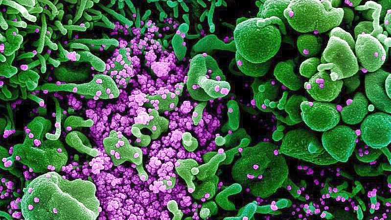 Eine Zelle (grün) ist mit dem Coronavirus (SARS-CoV-2, violett) infiziert. Die Probe wurde von einem Patienten in den USA isoliert. Foto: Niaid/Europa Press/dpa