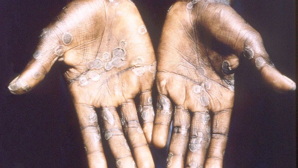 Die Handflächen eines Affenpockenpatienten zeigen einen Ausschlag. Foto: -/CDC/Brian W.J. Mahy/dpa/Archiv
