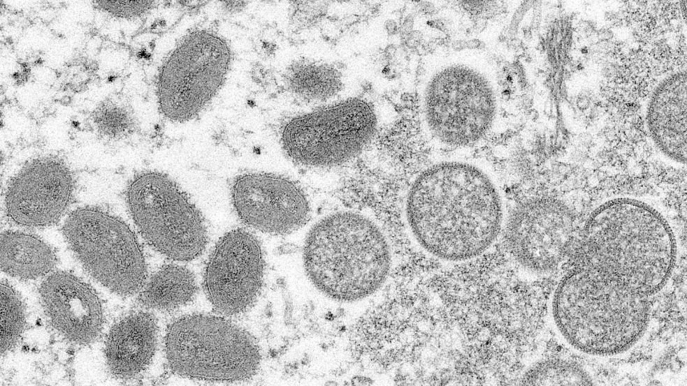 Diese elektronenmikroskopische Aufnahme zeigt reife, ovale Affenpockenviren (l) und kugelförmige unreife Virionen (r), die aus einer menschlichen Hautprobe stammt. Foto: Cynthia S. Goldsmith/Russell Regner/CDC/AP/dpa