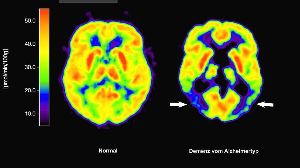 Lecanemab richtet sich gegen Amyloid-Ablagerungen im Gehirn und soll dadurch den Verlauf der Krankheit ein wenig verlangsamen. (Archivbild) Foto: Lutz Kracht/MPI/dpa