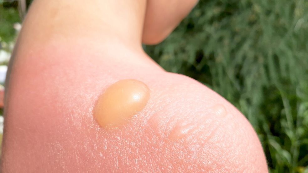 Eltern erheben schwere Vorwürfe: Einige Schüler sollen mit starken Sonnenbränden mit Blasenbildung von ihrer Sylt-Klassenfahrt zurückgekehrt sein. Das Foto ist ein Beispiel und zeigt keines der betroffenen Kinder. Foto: www.imago-images.de