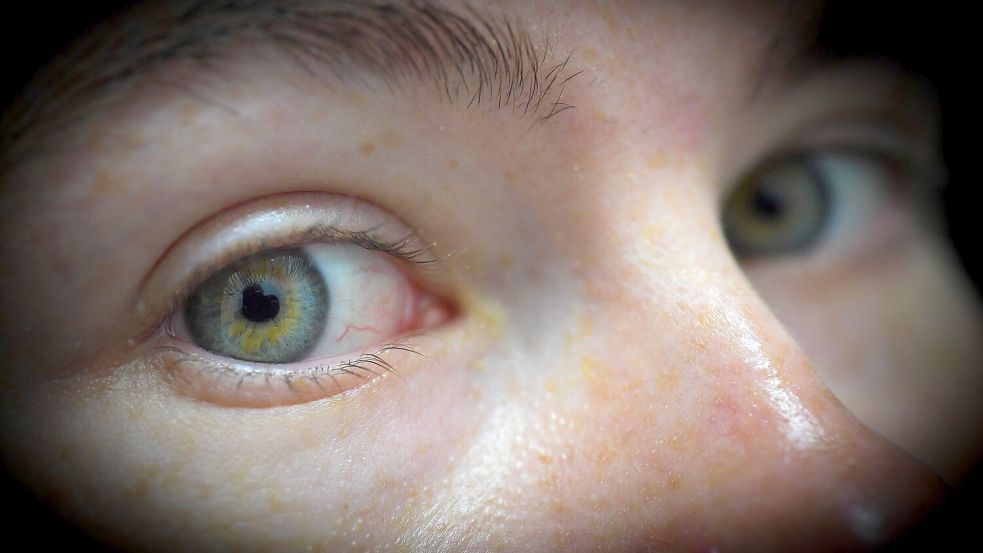 Unter anderem die Hornhaut der Augen kann gespendet werden. Das geht allerdings nur nach dem Tod. Foto: Klaus Ortgies