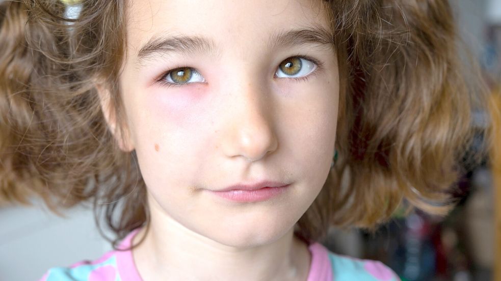 Ein Mückenstich am Auge sollte immer beobachtet werden. Hier kann die Schwellung in tiefere Bereiche vordringen und das Auge gefährden. Foto: IMAGO/Zoonar