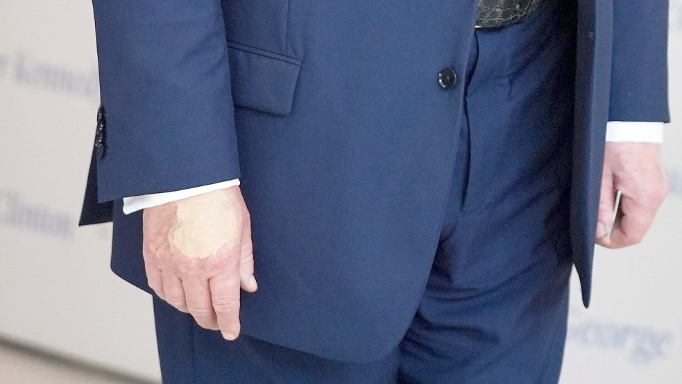 Für Trump ein unliebsames Thema: die überschminkte Hand (Archivbild). Foto: Evan Vucci/AP/dpa