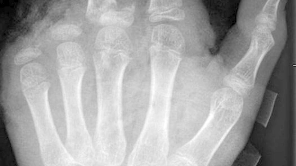 So kann ein Röntgenbild nach einer missglückten Böllerexplosion aussehen: Zwei Finger fehlen. Foto: -/UKB/dpa