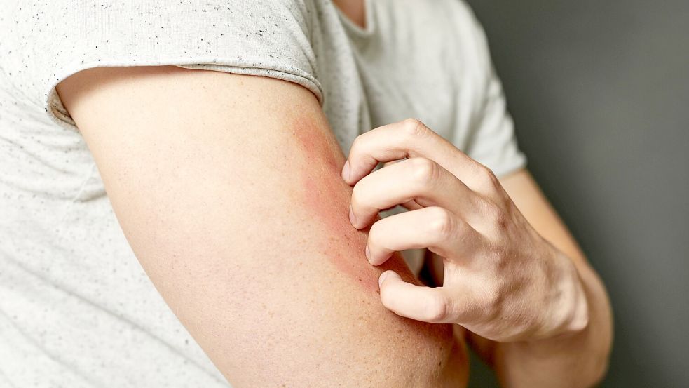 Eine Infektion mit Krätze kann zu einem äußerst quälenden, schmerzhaften Juckreiz führen. Foto: Maria Fuchs/stock.adobe.com