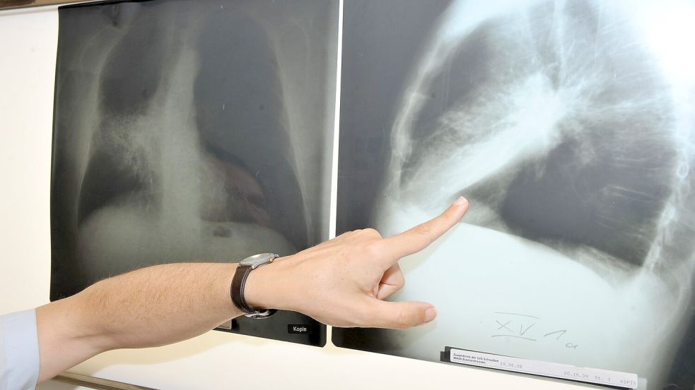 Ein Arzt zeigt auf ein Röntgenbild einer von Krebs befallenen Lunge. Foto: Felix Hörhager/dpa