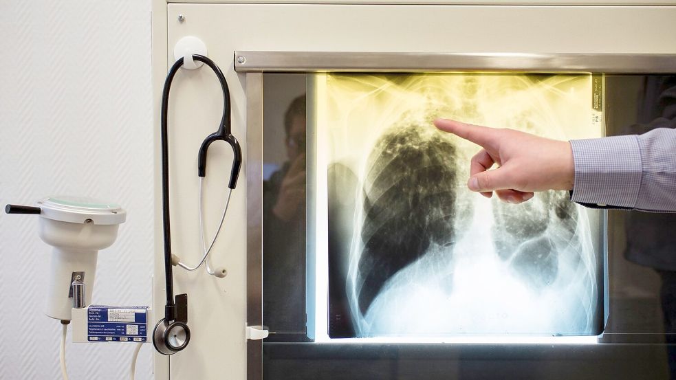 Tuberkulose-Erkrankungen werden in Europa oft nicht erkannt. (Illustration) Foto: Gregor Fischer/Deutsche Presse-A
